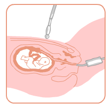 Vlokkentest via de vagina